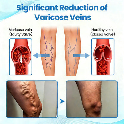 🇬🇧👨‍⚕️👍GFOUK® VascuCare Vein Healing Spray(Designed for Varicose veins, Spider veins, Deep vein Thrombosis, Chronic venous insufficiency, Venous ulcers, Thrombophlebitis and other venous issues)