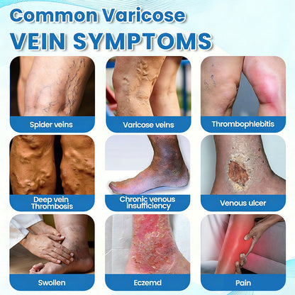🇬🇧👨‍⚕️👍GFOUK® VascuCare Vein Healing Spray(Designed for Varicose veins, Spider veins, Deep vein Thrombosis, Chronic venous insufficiency, Venous ulcers, Thrombophlebitis and other venous issues)