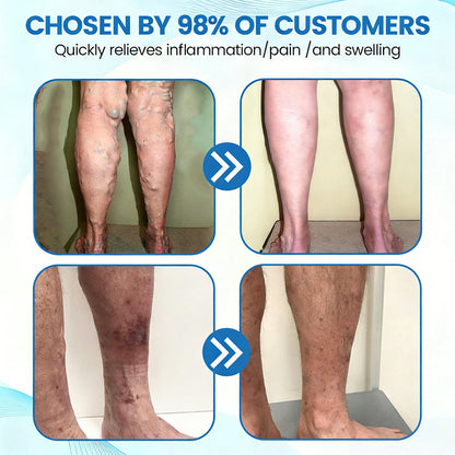 🇬🇧👨‍⚕️👍GFOUK® VascuCare Vein Healing Spray(Designed for Varicose veins, Spider veins, Deep vein Thrombosis, Chronic venous insufficiency, Venous ulcers, Thrombophlebitis and other venous issues)