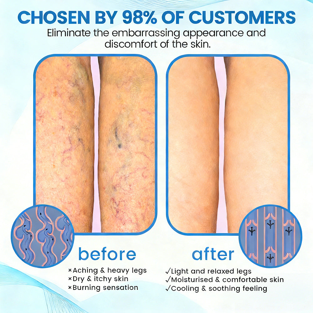 🇬🇧👨‍⚕️👍GFOUK® VascuCare Vein Healing Spray(Designed for Varicose veins, Spider veins, Deep vein Thrombosis, Chronic venous insufficiency, Venous ulcers, Thrombophlebitis and other venous issues)