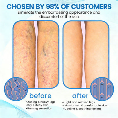 🇬🇧👨‍⚕️👍GFOUK® VascuCare Vein Healing Spray(Designed for Varicose veins, Spider veins, Deep vein Thrombosis, Chronic venous insufficiency, Venous ulcers, Thrombophlebitis and other venous issues)