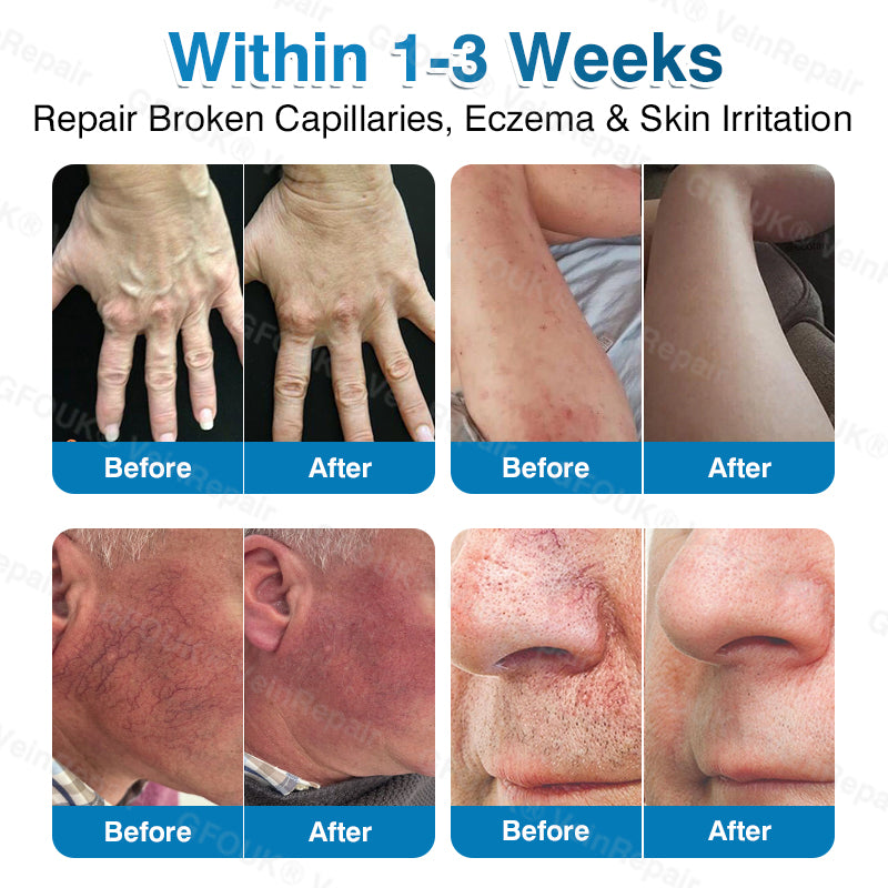 🇬🇧🏆✅️🏃GFOUK® VeinRepair Microneedle Patch Roll⚡Instant Relief, Long-Term Results