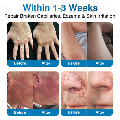 🇬🇧👨‍⚕️👨‍⚕️✅GFOUK® VeinRepair Microneedle Patch Roll⚡Instant Relief, Long-Term Results