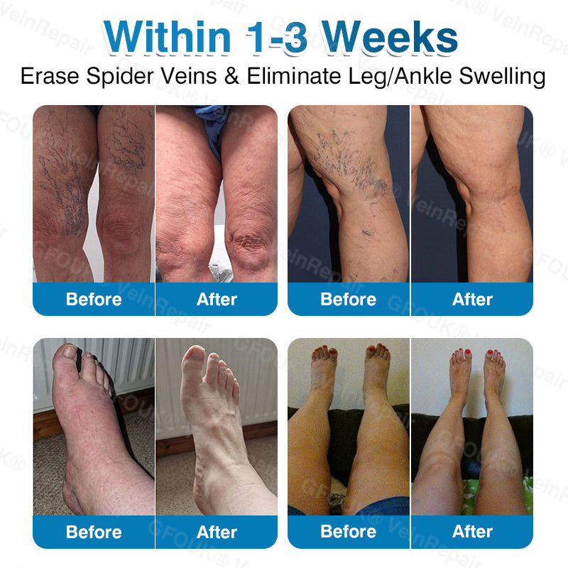 🇬🇧👨‍⚕️👨‍⚕️✅GFOUK® VeinRepair Microneedle Patch Roll⚡Instant Relief, Long-Term Results