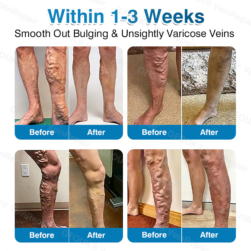 🇬🇧🏆✅️🏃GFOUK® VeinRepair Microneedle Patch Roll⚡Instant Relief, Long-Term Results