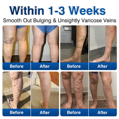 uk👨‍⚕️🦵🛡️GFOUK® VeinRenew Microneedle Balm