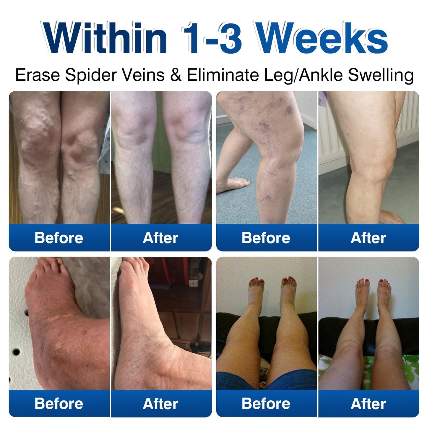 uk👨‍⚕️🦵🛡️GFOUK® VeinRenew Microneedle Balm