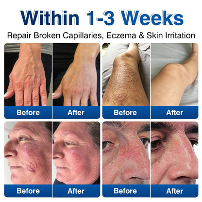 uk👨‍⚕️🦵🛡️GFOUK® VeinRenew Microneedle Balm