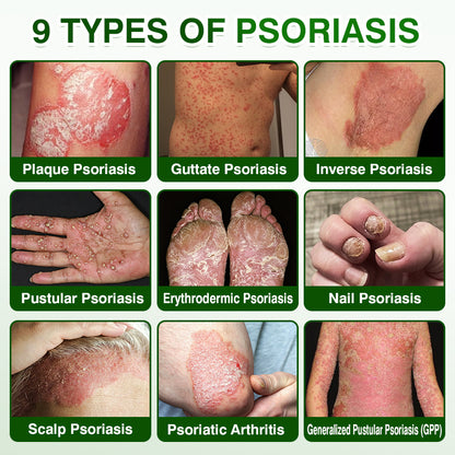 🇬🇧🎁DOCTIA® SkinRecovery Reishi Psoriasis Repair Spray