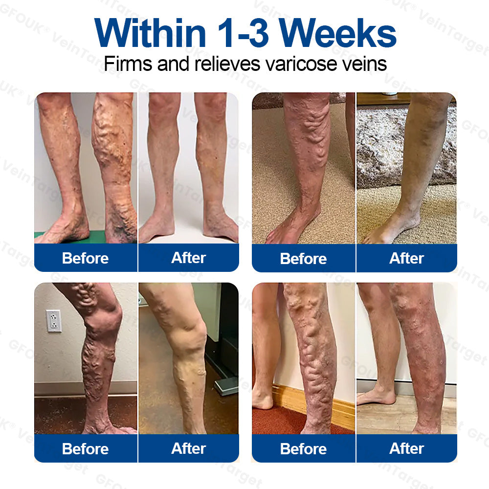 🇬🇧👨‍⚕️🥇✅GFOUK® VeinTarget Microneedle Patch⚡Instant Relief, Long-Term Results