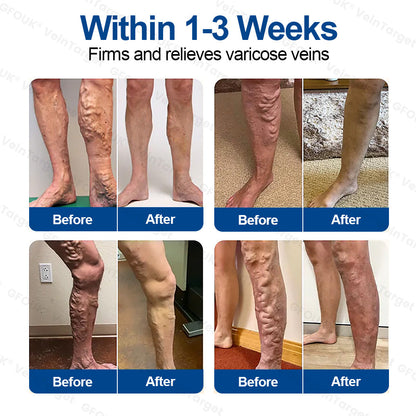 🇬🇧👨‍⚕️🥇✅GFOUK® VeinTarget Microneedle Patch⚡Instant Relief, Long-Term Results