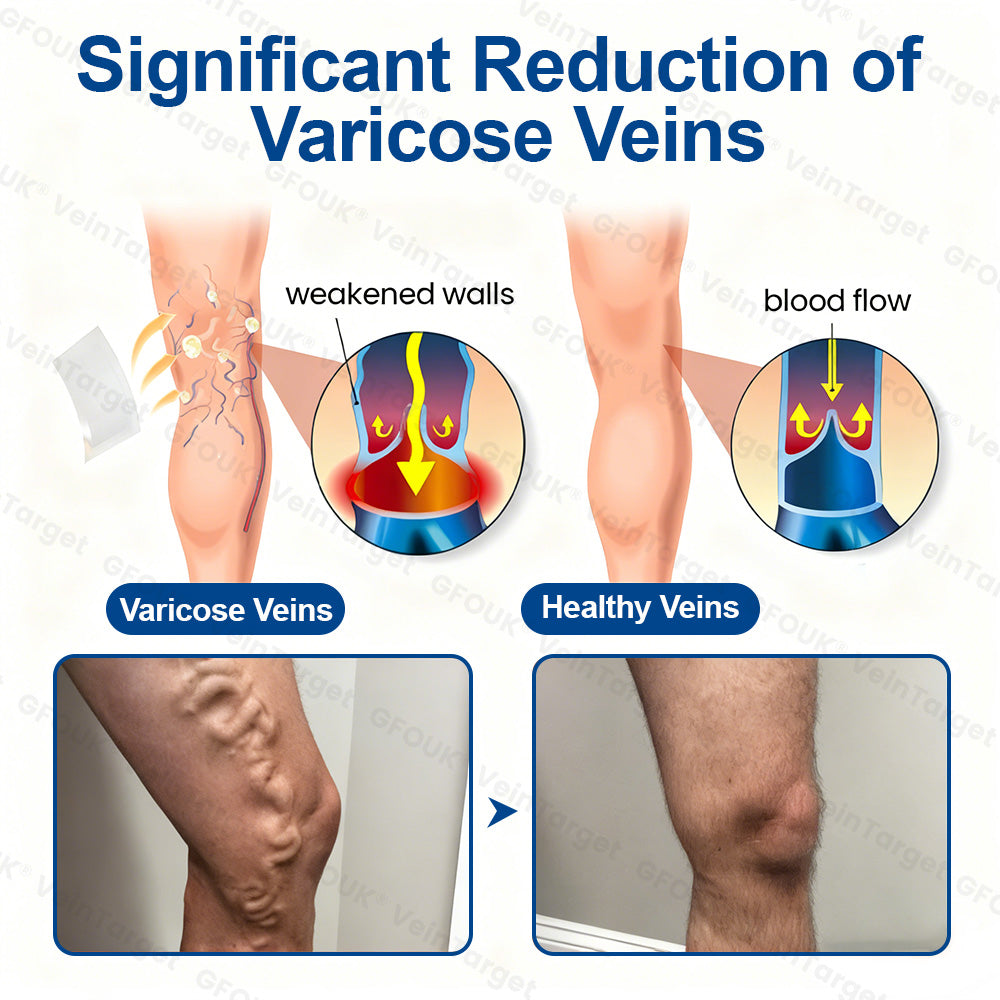 🇬🇧👨‍⚕️🥇✅GFOUK® VeinTarget Microneedle Patch⚡Instant Relief, Long-Term Results